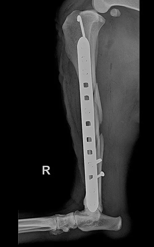 Combination of polyaxial locking plating 2