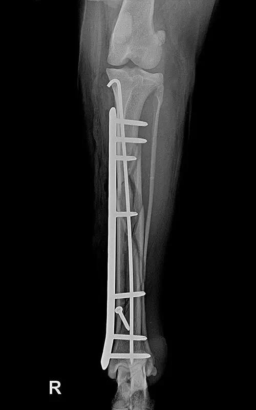 Combination of polyaxial locking plating 3