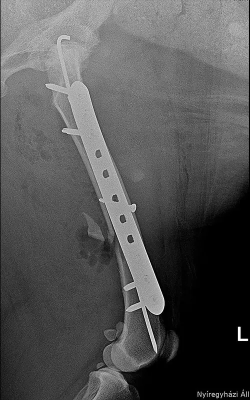 Combination of polyaxial locking plating 5