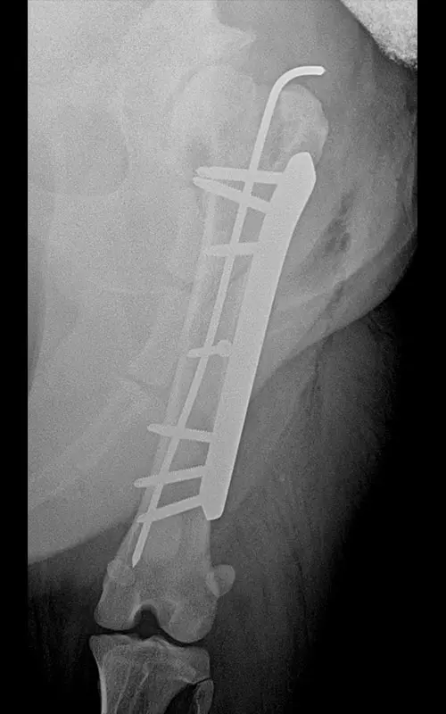 Combination of polyaxial locking plating 7