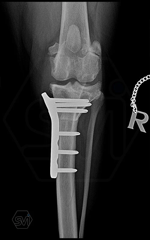 The NEW precontoured polyaxial locking TPLO plate family 3