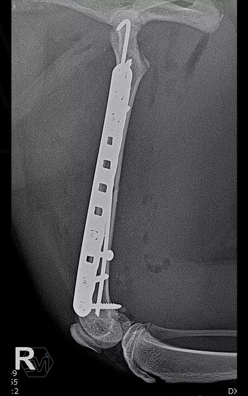 NEW! The polyaxial locking system in size 2.0 mm have arrived! 3