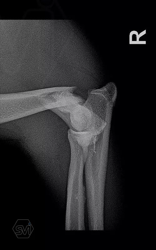 What used to be a nightmare type of surgery 1