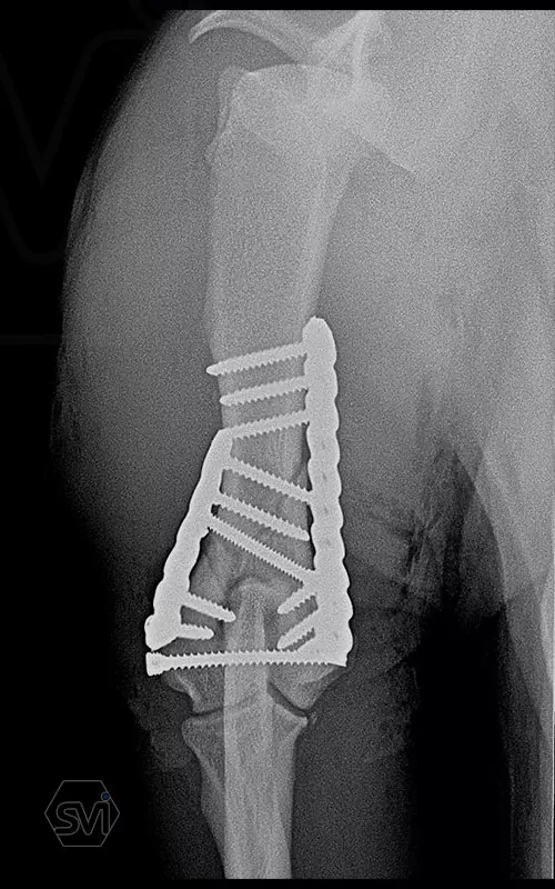 What used to be a nightmare type of surgery 4